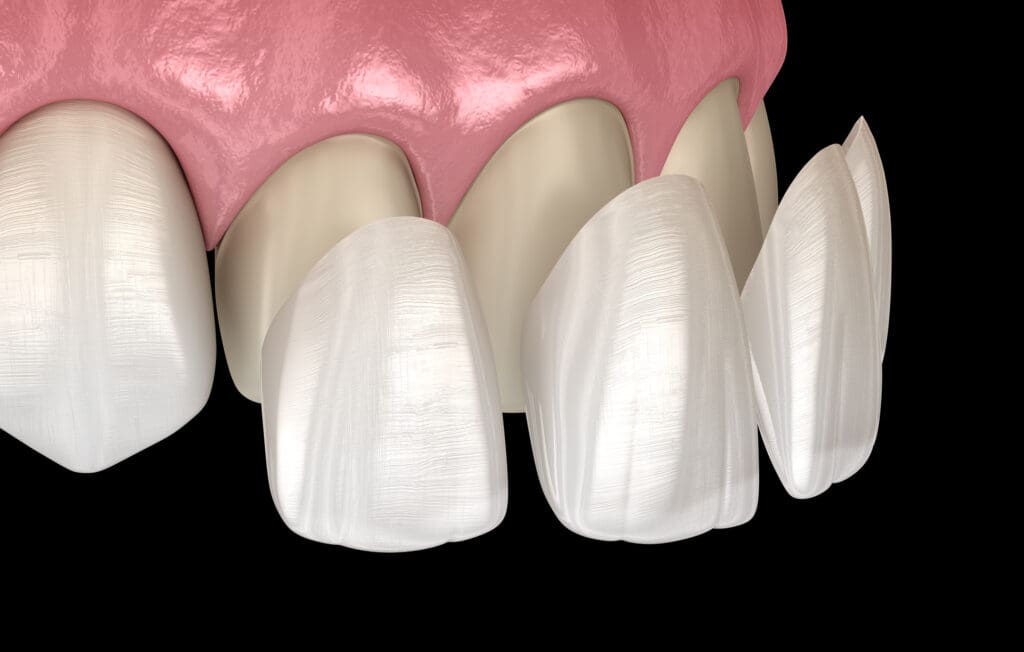Les facettes dentaires Smile Implant