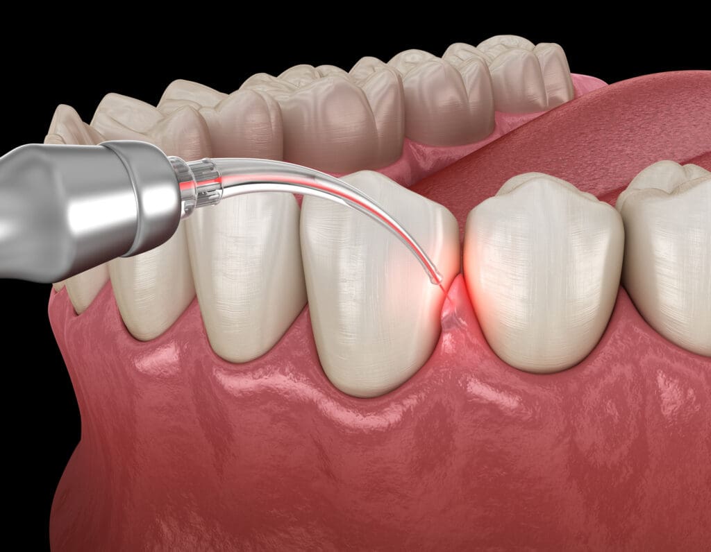 Le soin des gencives Smile Implant
